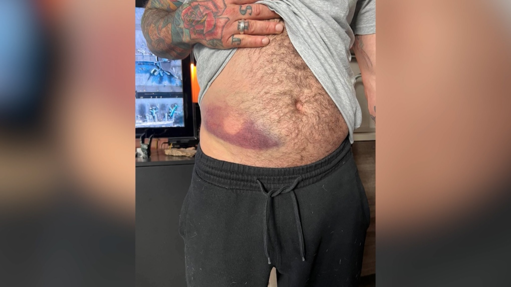 Un uomo colpito da proiettili di gomma durante una manifestazione a Vancouver